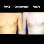 gynecomastia.007