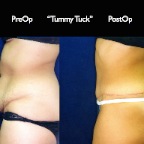TummyTuck.016