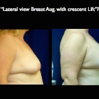 Breast-Aug.006