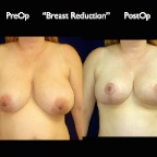 Breast Reduction.001