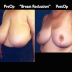 Breast Reduction.005
