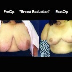 Breast Reduction.012