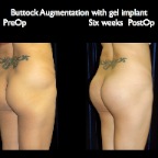 Butt-Imp-pos6wkspo.011