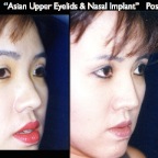 Eyelids.042