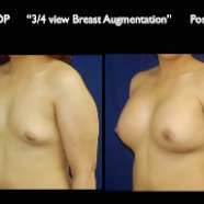 Breast-Aug.035