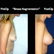 Breast-Aug2.025